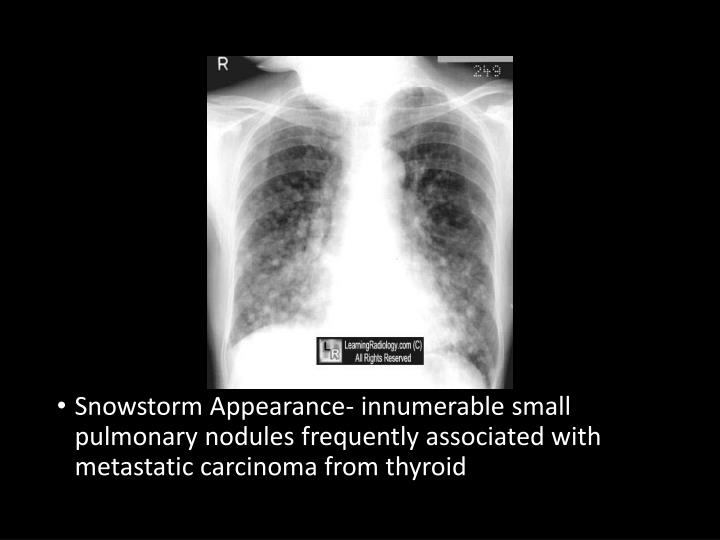 Snowstorm appearance chest x ray stormsnow