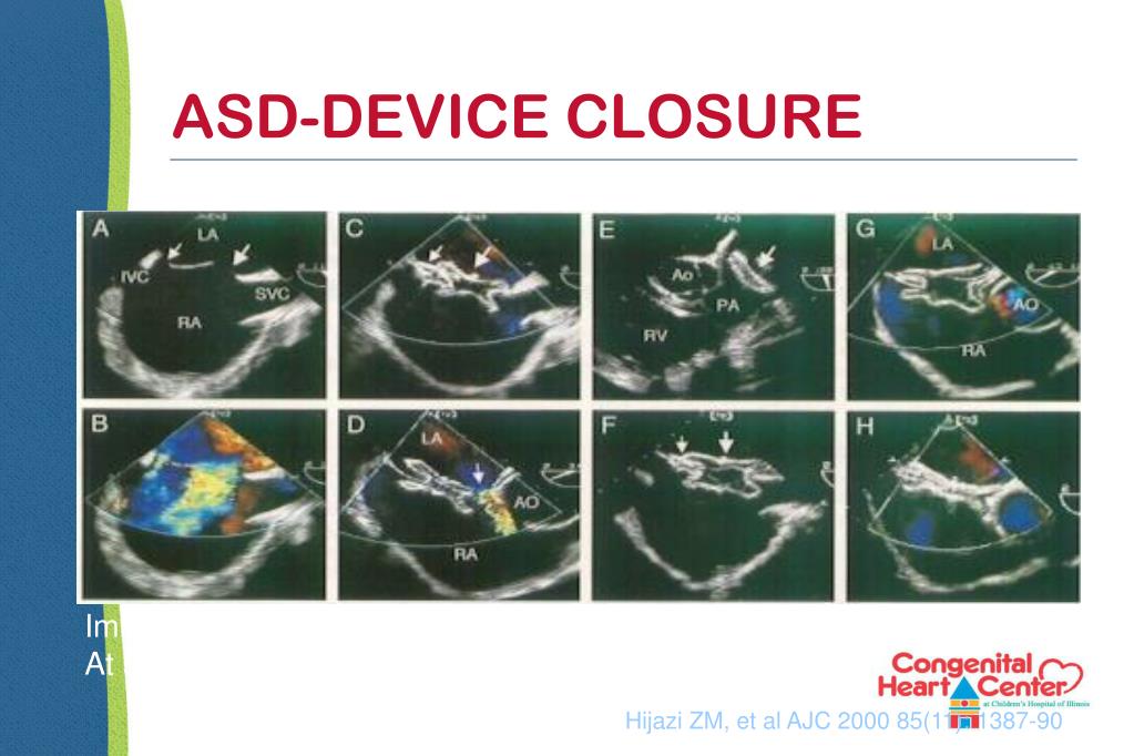 PPT Newborn Congenital Heart Disease Screening and Management