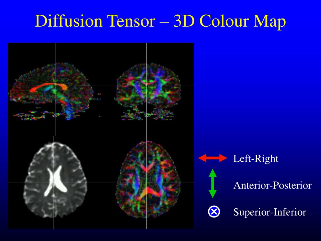 PPT MR Diffusion Tensor Imaging, Tractography PowerPoint Presentation
