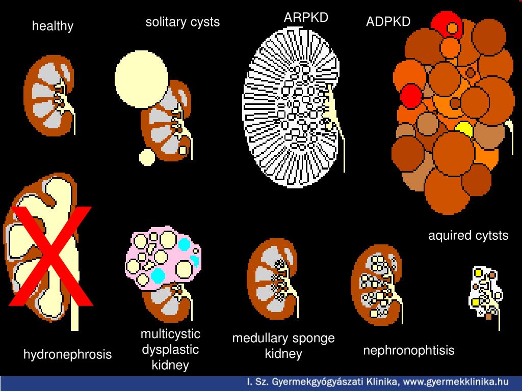 PPT Gender and kidney diseases PowerPoint Presentation, free download