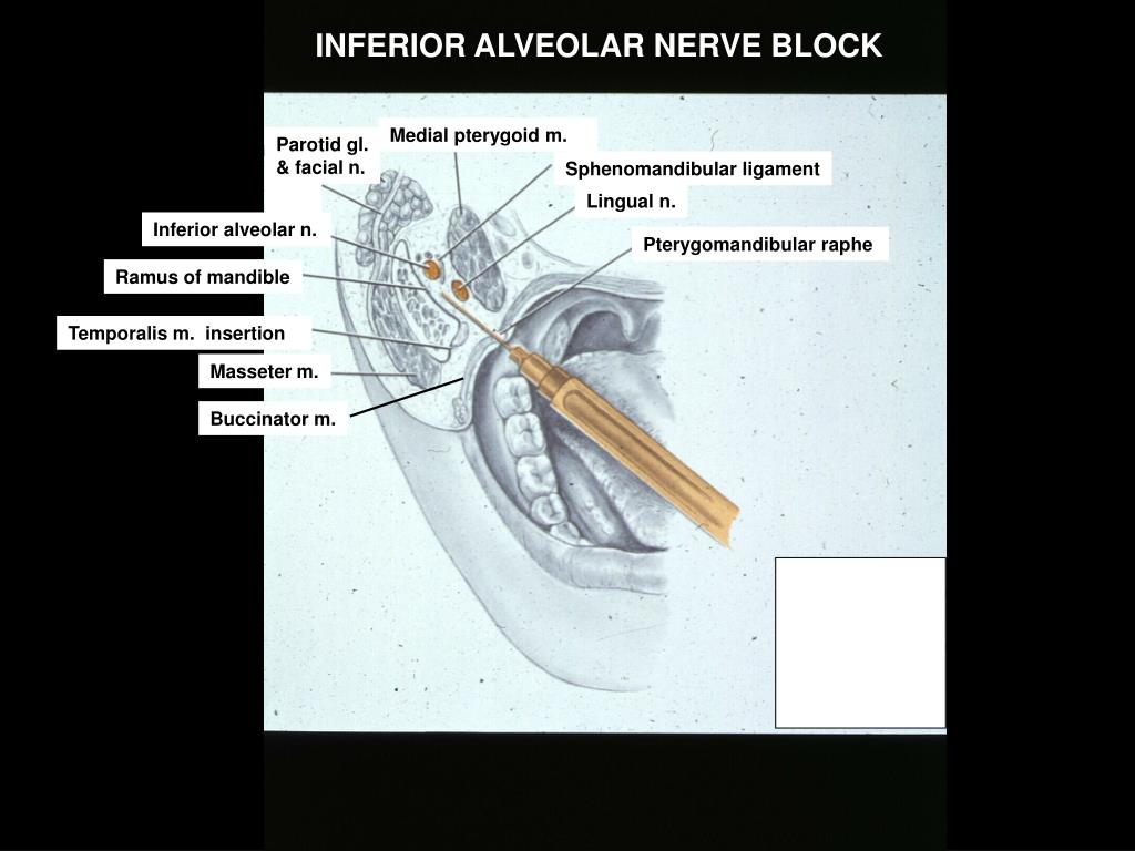 PPT DENTAL GROSS ANATOMY CASE 4.1 (INFERIOR ALVEOLAR NERVE BLOCK