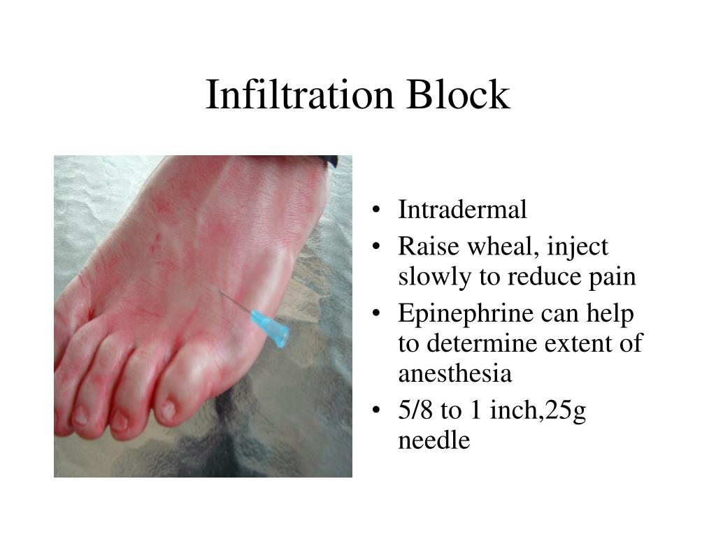 PPT Anesthetic and Therapeutic Injections of the Foot and Ankle