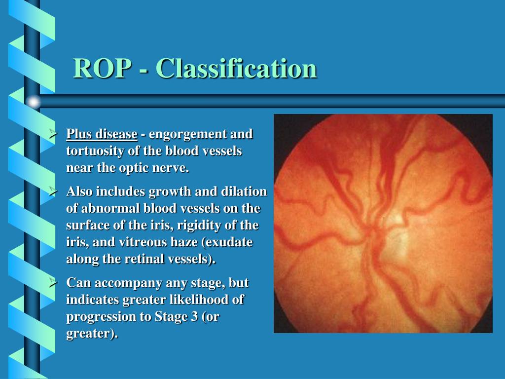 PPT Retinopathy Of Prematurity PowerPoint Presentation, free download