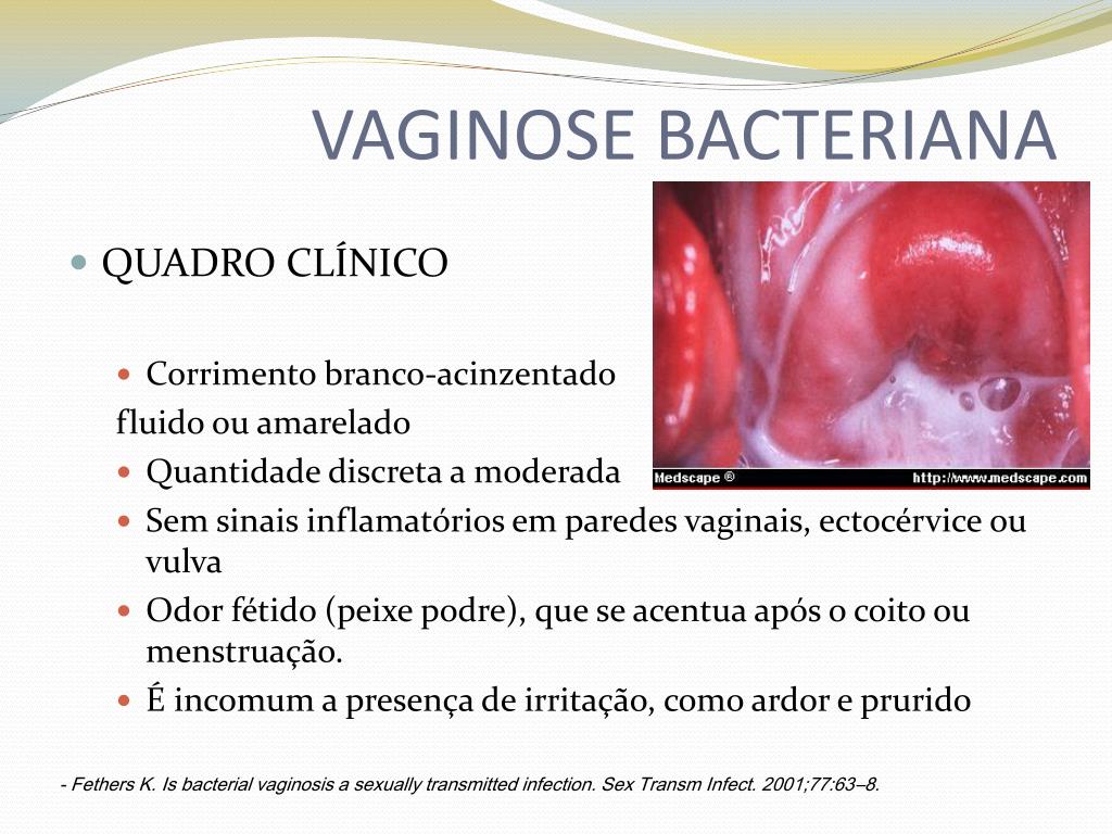 Corrimento Branco Com Odor De Peixe