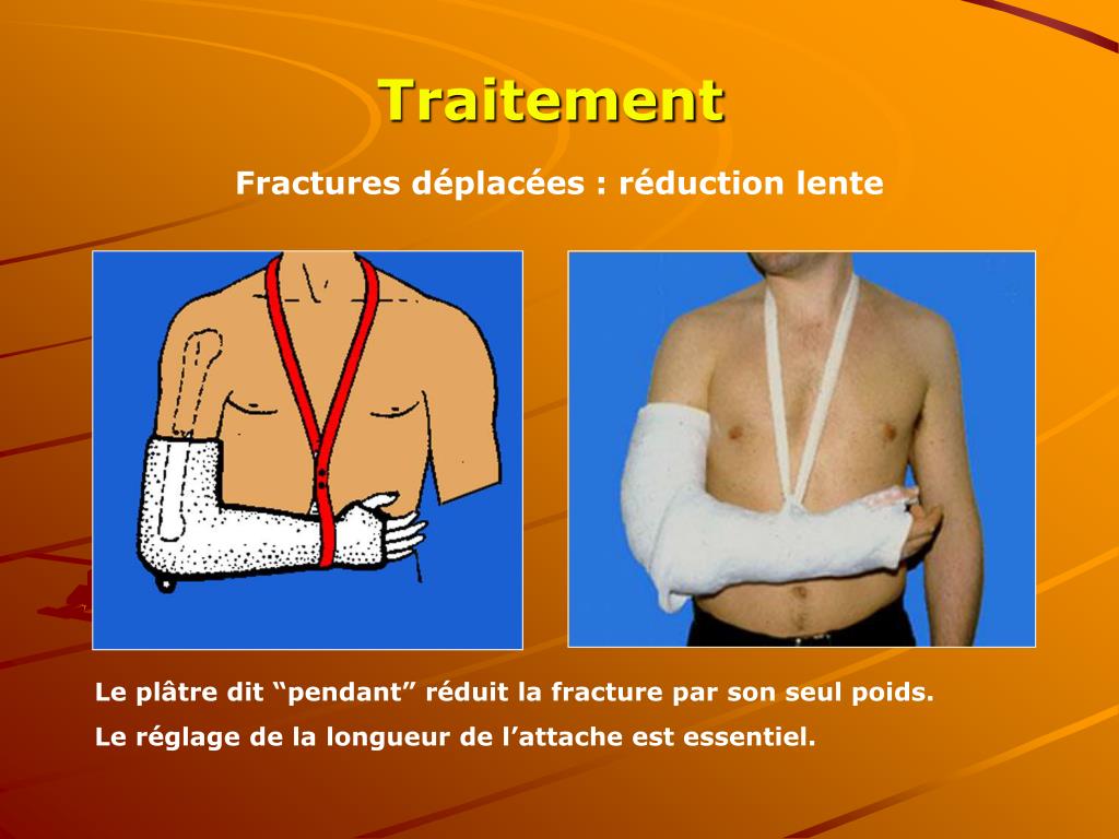 PPT Fractures de la clavicule PowerPoint Presentation, free download