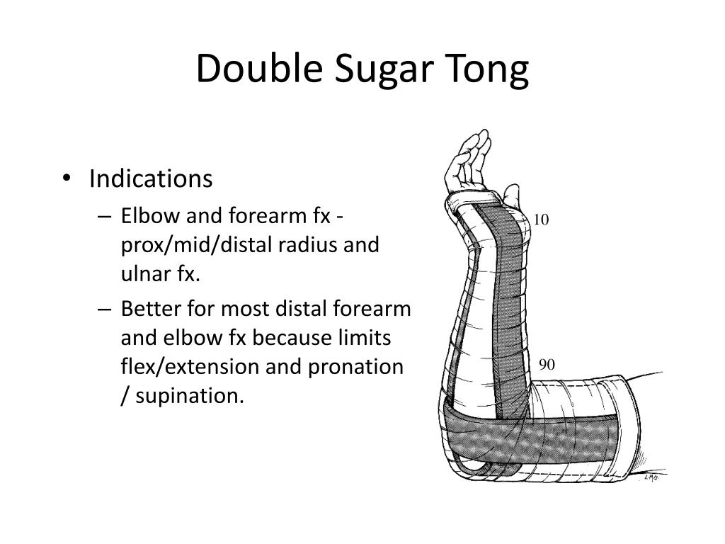 PPT Splinting Broward General Medical Center PowerPoint