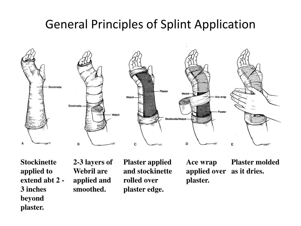 PPT Splinting Broward General Medical Center PowerPoint