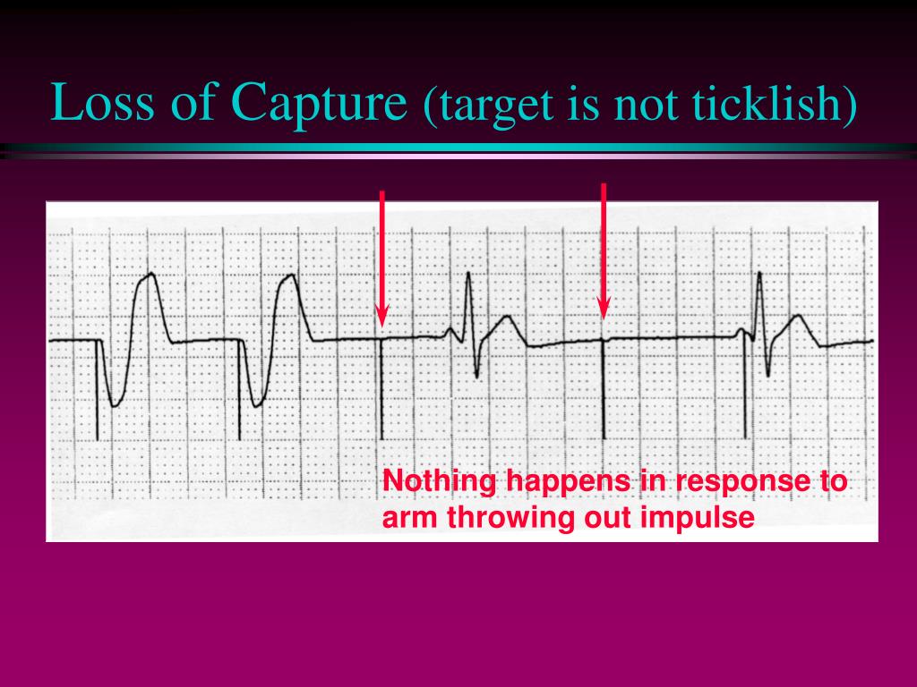 PPT - Pacemaker Malfunctions PowerPoint Presentation, free download