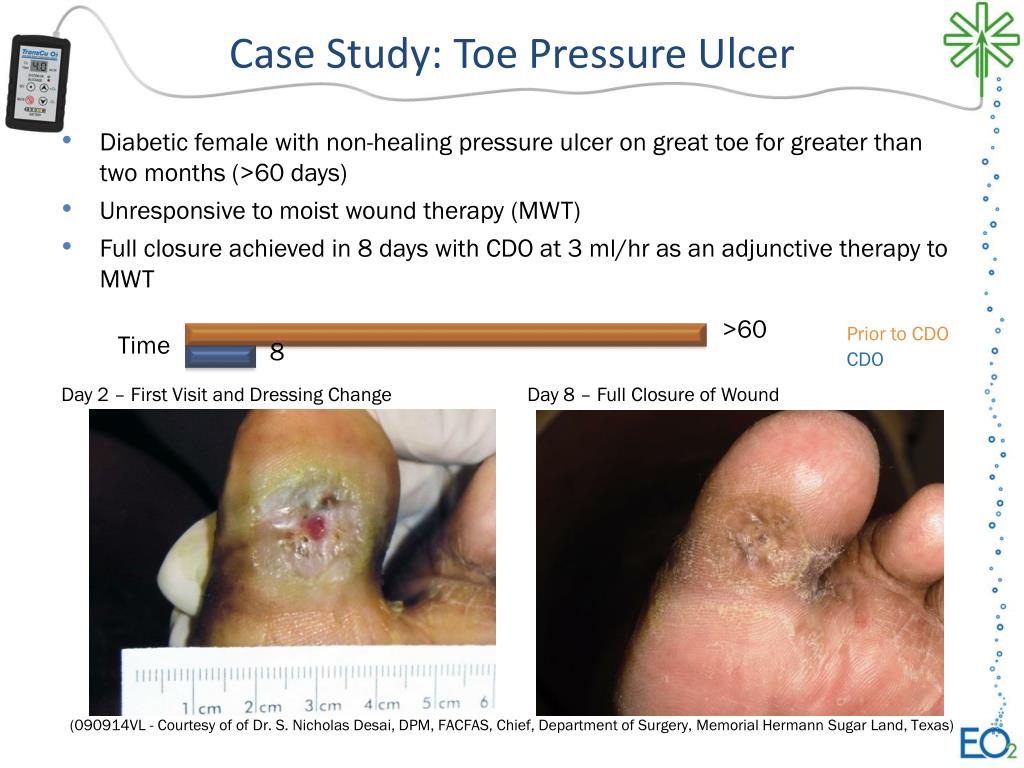 PPT Case Study Toe Pressure Ulcer PowerPoint Presentation, free
