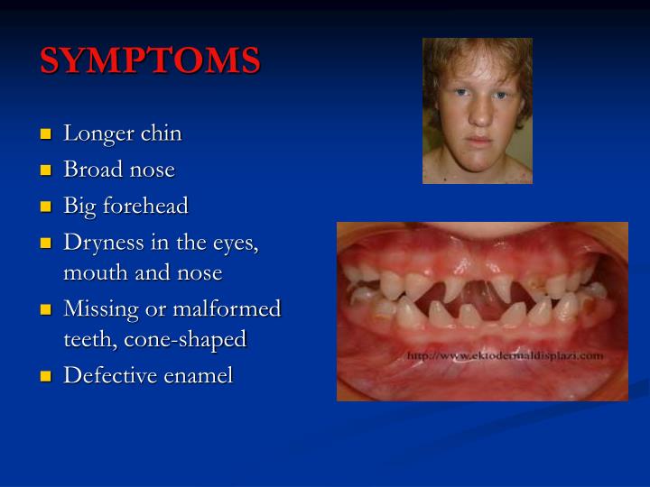 PPT ECTODERMAL DYSPLASIA DENTAL CALAMITY IN YOUR MOUTH. PowerPoint