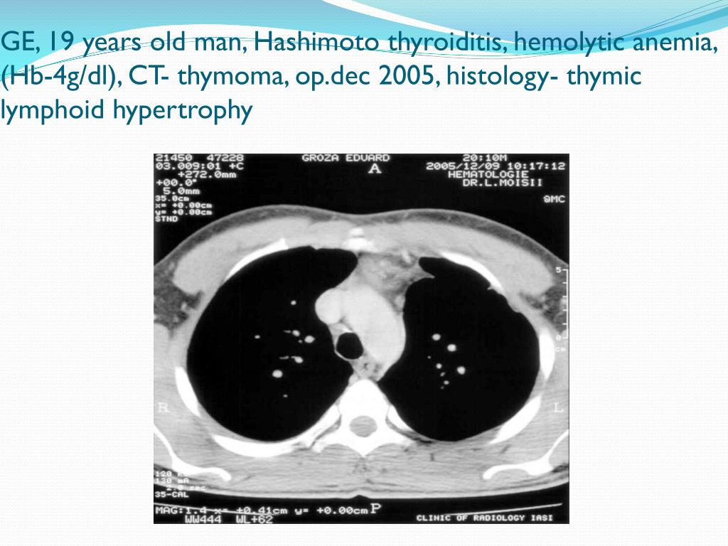 PPT THYMOMAS PowerPoint Presentation, free download ID4430473