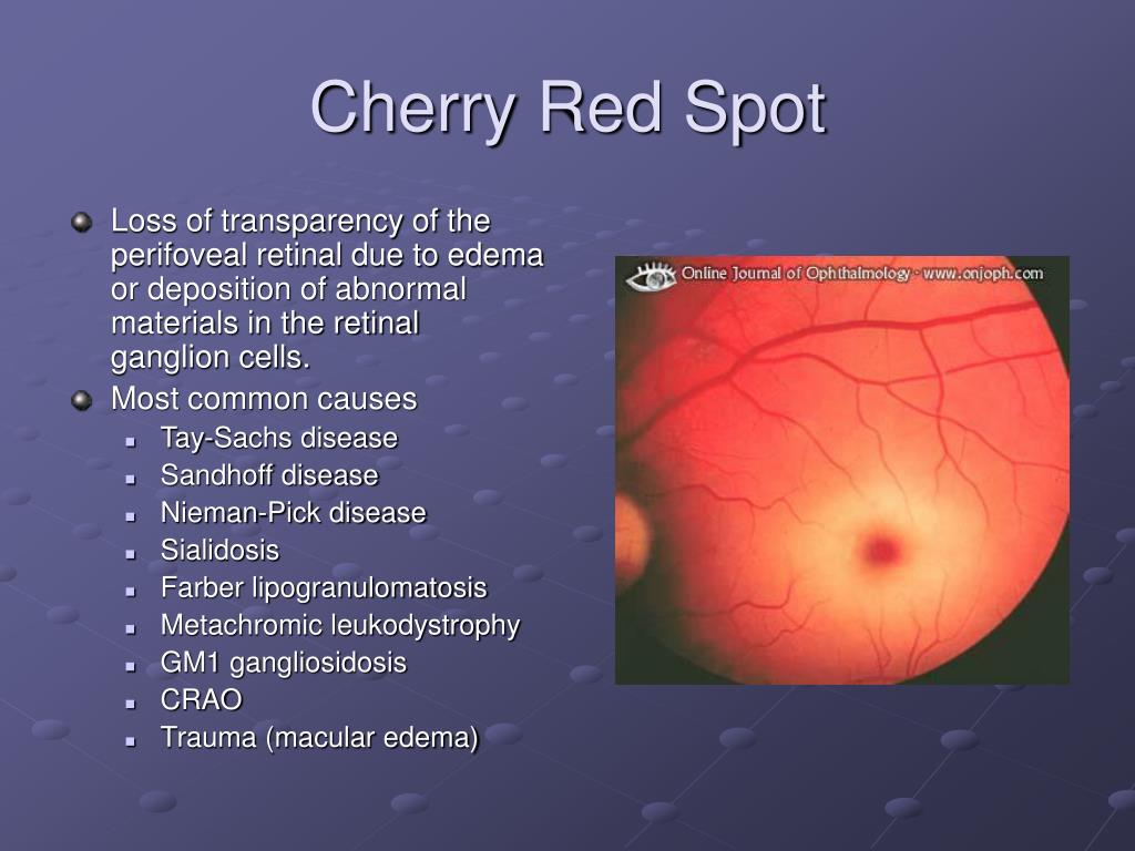 Cherry Red Spot Developmental Delay at Fred Hofman blog