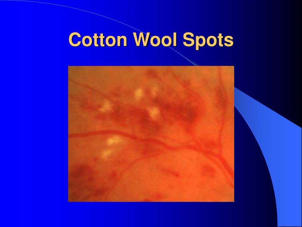 PPT Diabetic Retinopathy PowerPoint Presentation ID4457869