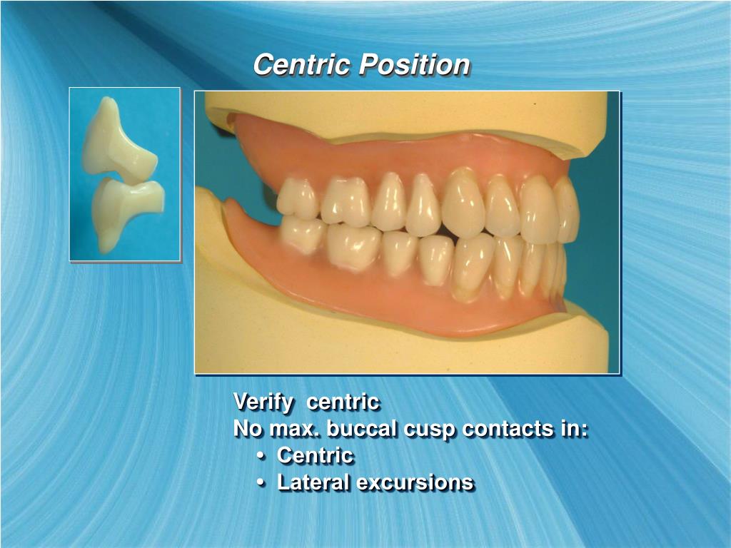 PPT Setting Posterior Teeth PowerPoint Presentation, free download