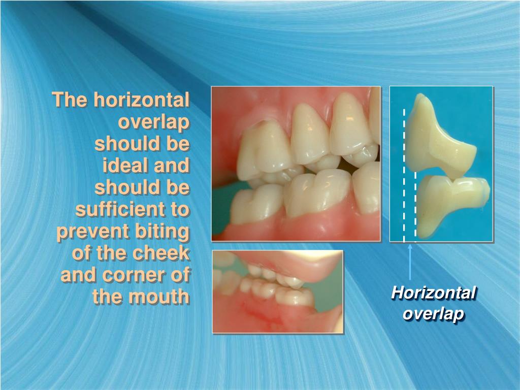 PPT Setting Posterior Teeth PowerPoint Presentation, free download