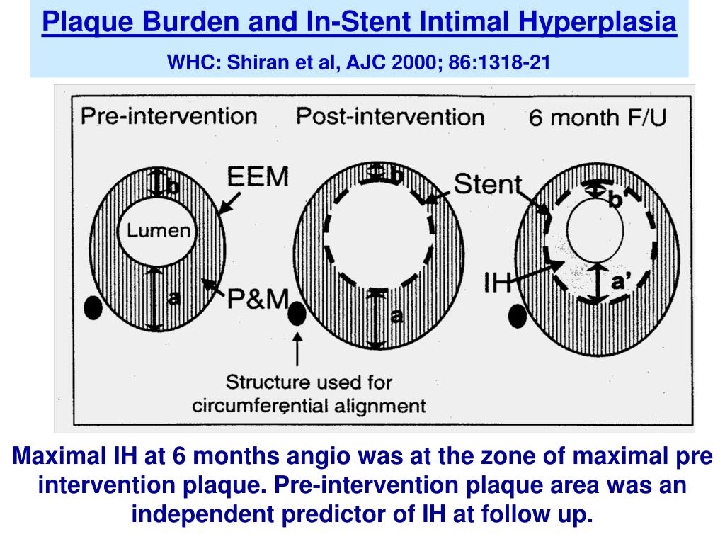 PPT Can IVUS Define Plaque Features that Impact Patient Care