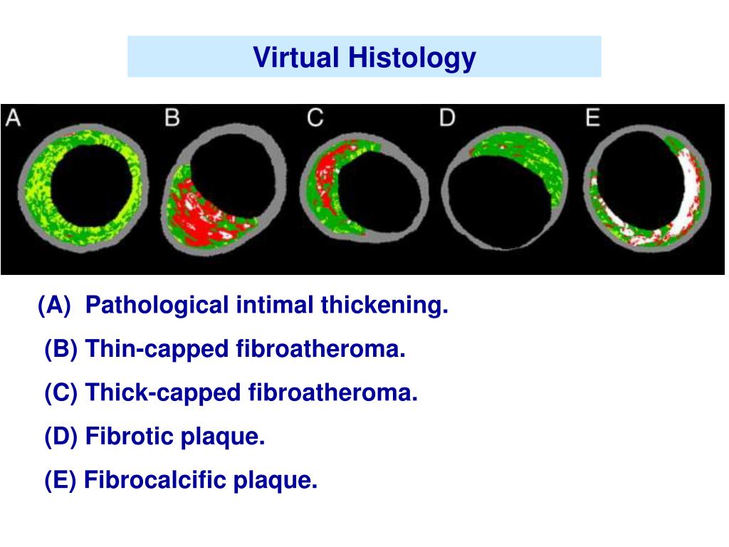 PPT Can IVUS Define Plaque Features that Impact Patient Care