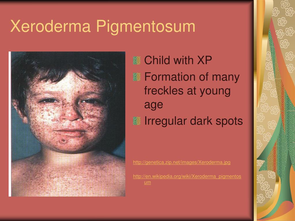 PPT Xeroderma Pigmentosum PowerPoint Presentation, free download ID