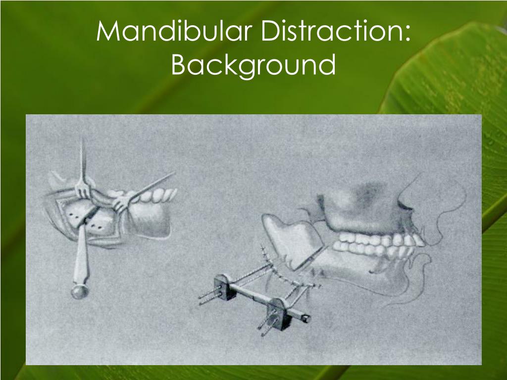 PPT Early Mandibular Distraction Osteogenesis in Pierre Robin