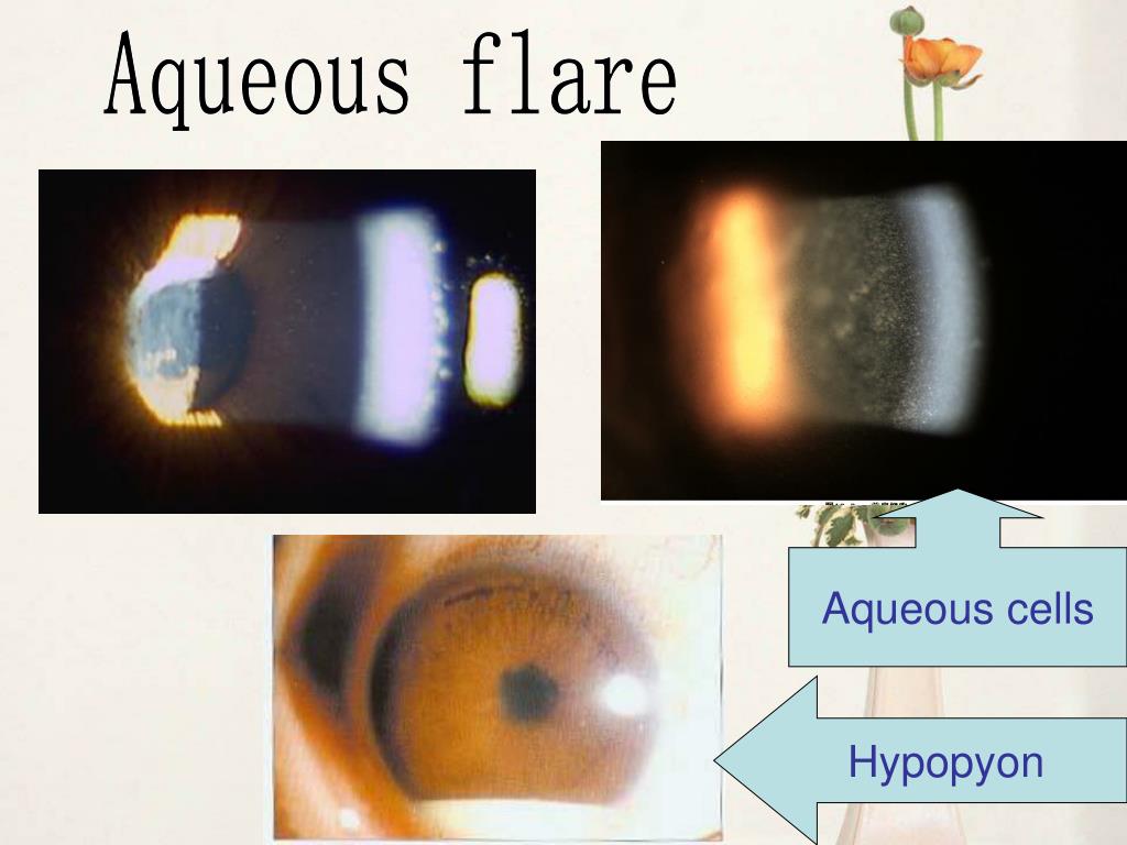 PPT Uveal Disease PowerPoint Presentation, free download ID4558617