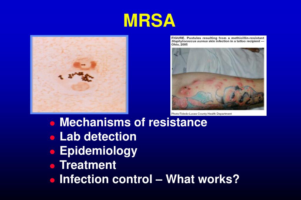 PPT MRSA PowerPoint Presentation, free download ID4567435