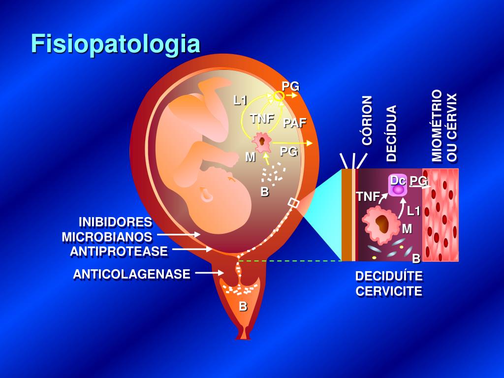 PPT Infecção do Trato Urinário na gestação PowerPoint Presentation