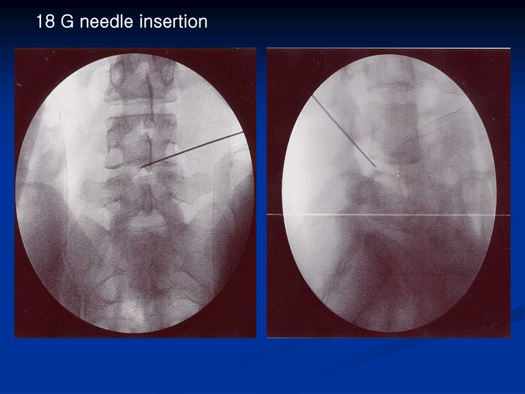 PPT PELD (Percutaneous Endoscopic Lumbar Discectomy) PowerPoint