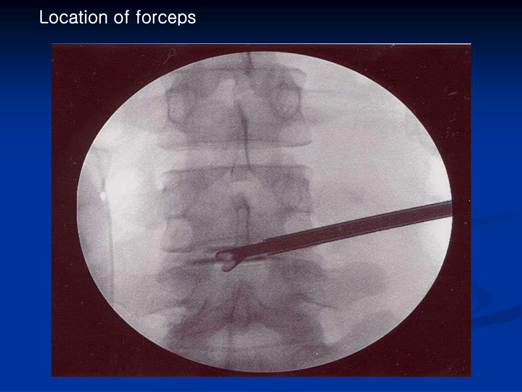 PPT PELD (Percutaneous Endoscopic Lumbar Discectomy) PowerPoint