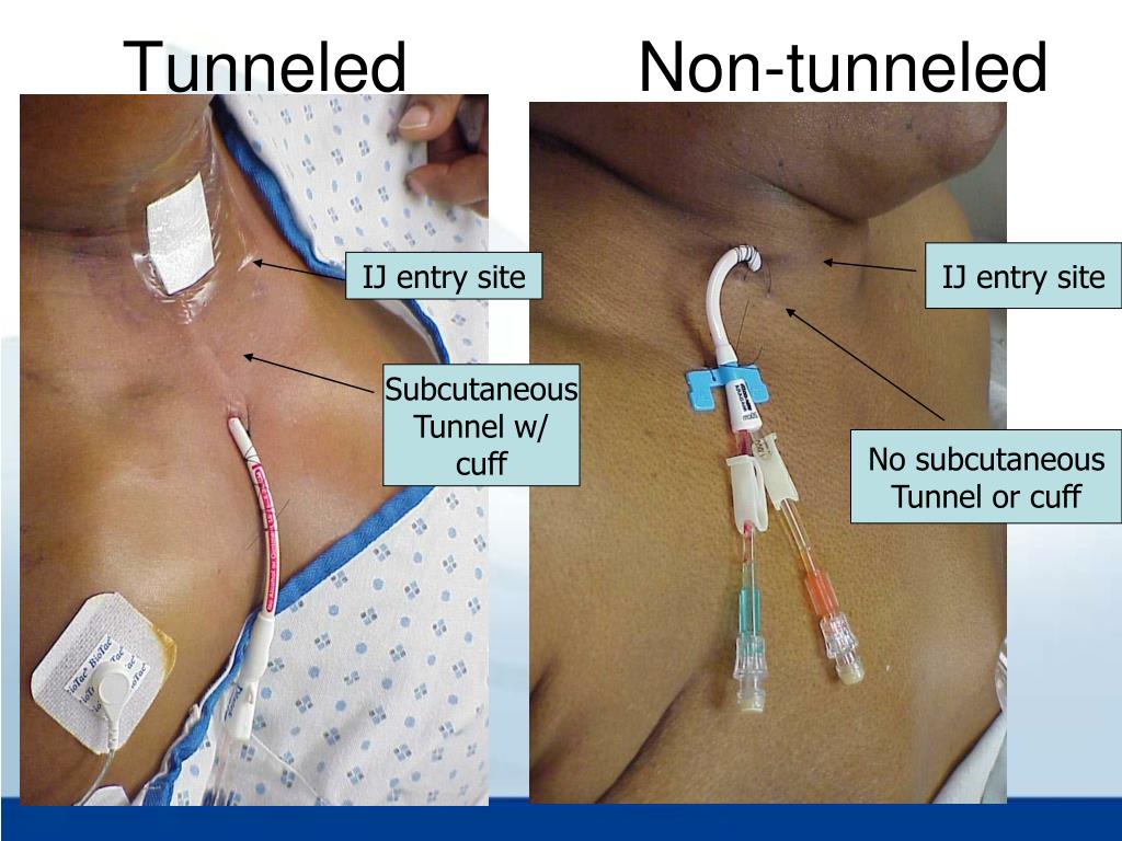 PPT Vascular Access at MUSC PowerPoint Presentation, free download