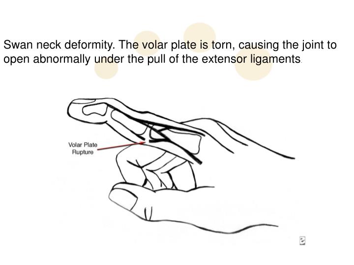 PPT Swan Neck Deformity PowerPoint Presentation ID4595264