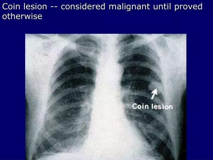 PPT Coin lesion considered malignant until proved otherwise