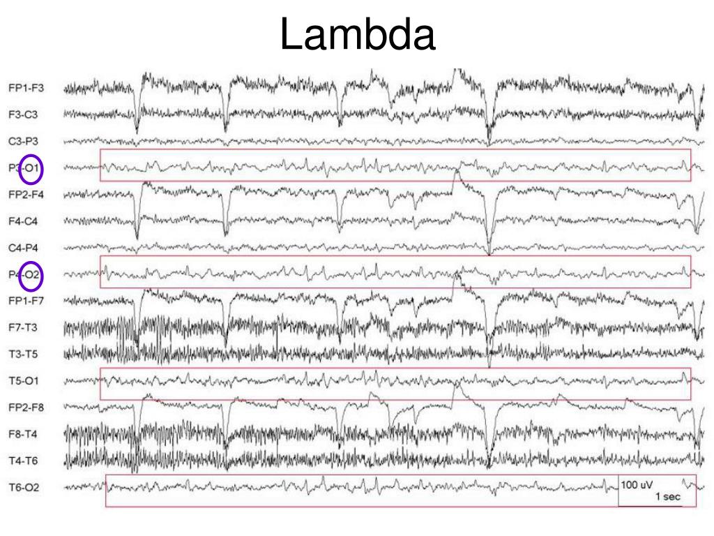 PPT Normal EEG in children EEG PowerPoint Presentation, free