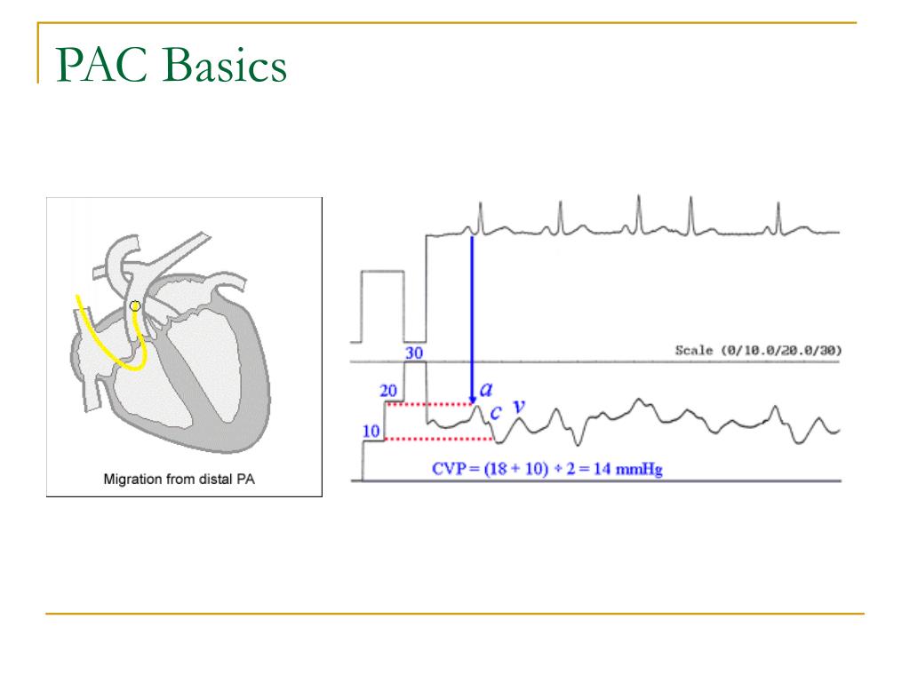 PPT Computerized PAC Waveform Interpretation PowerPoint Presentation