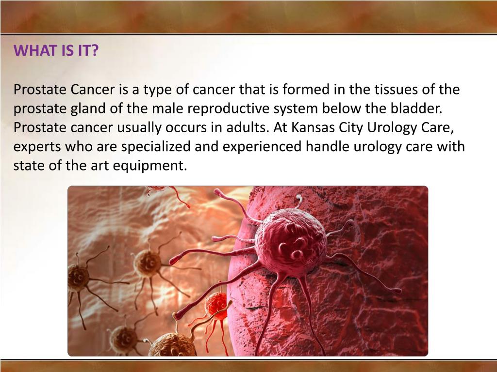 PPT Cutting edge technology helping prostate cancer treatment