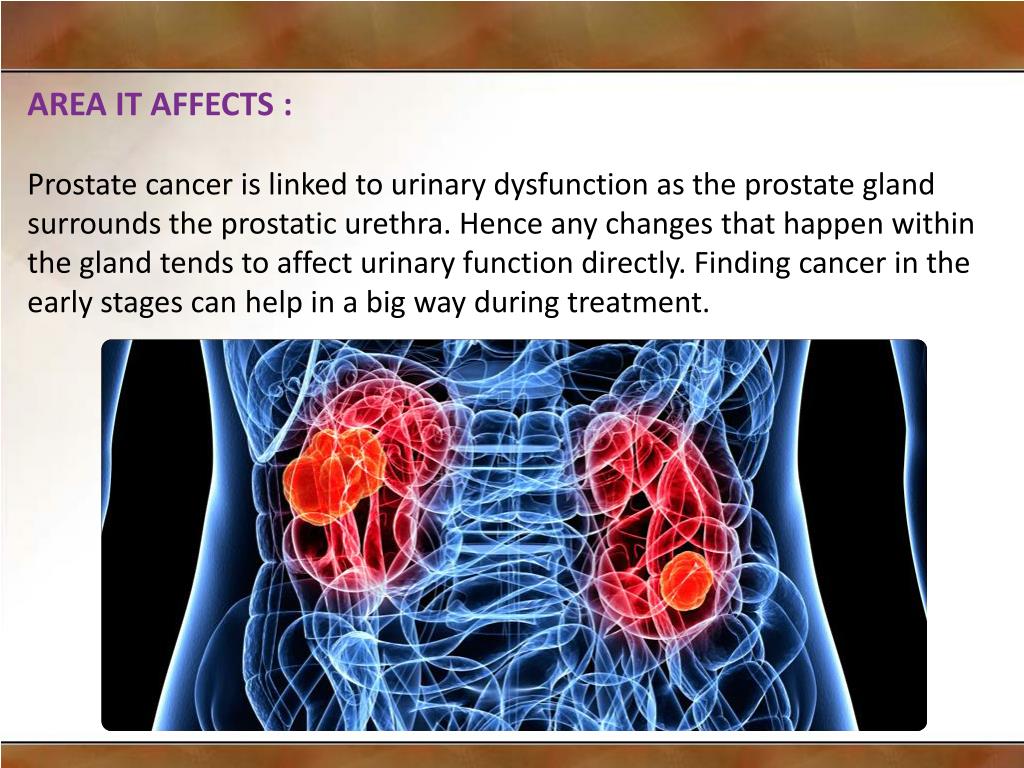 PPT Cutting edge technology helping prostate cancer treatment