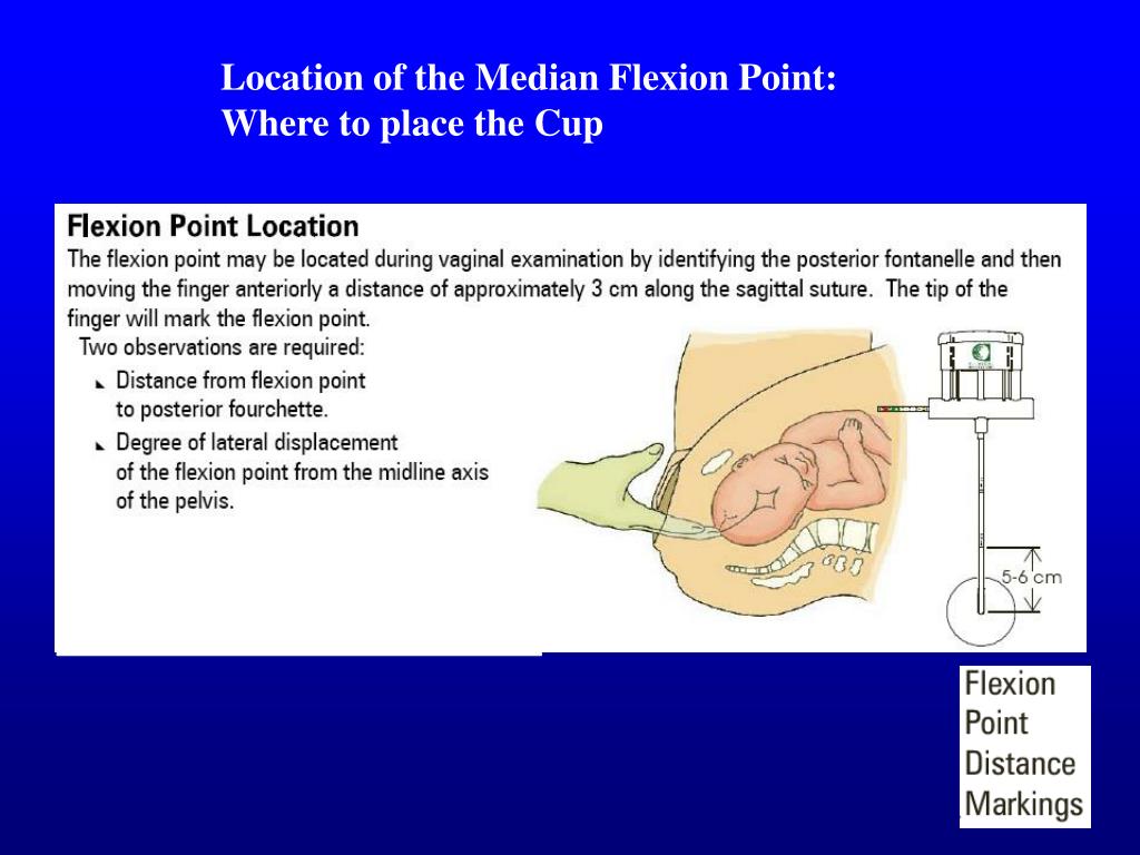 PPT Vacuum Assisted Vaginal Delivery PowerPoint Presentation, free download ID4720617