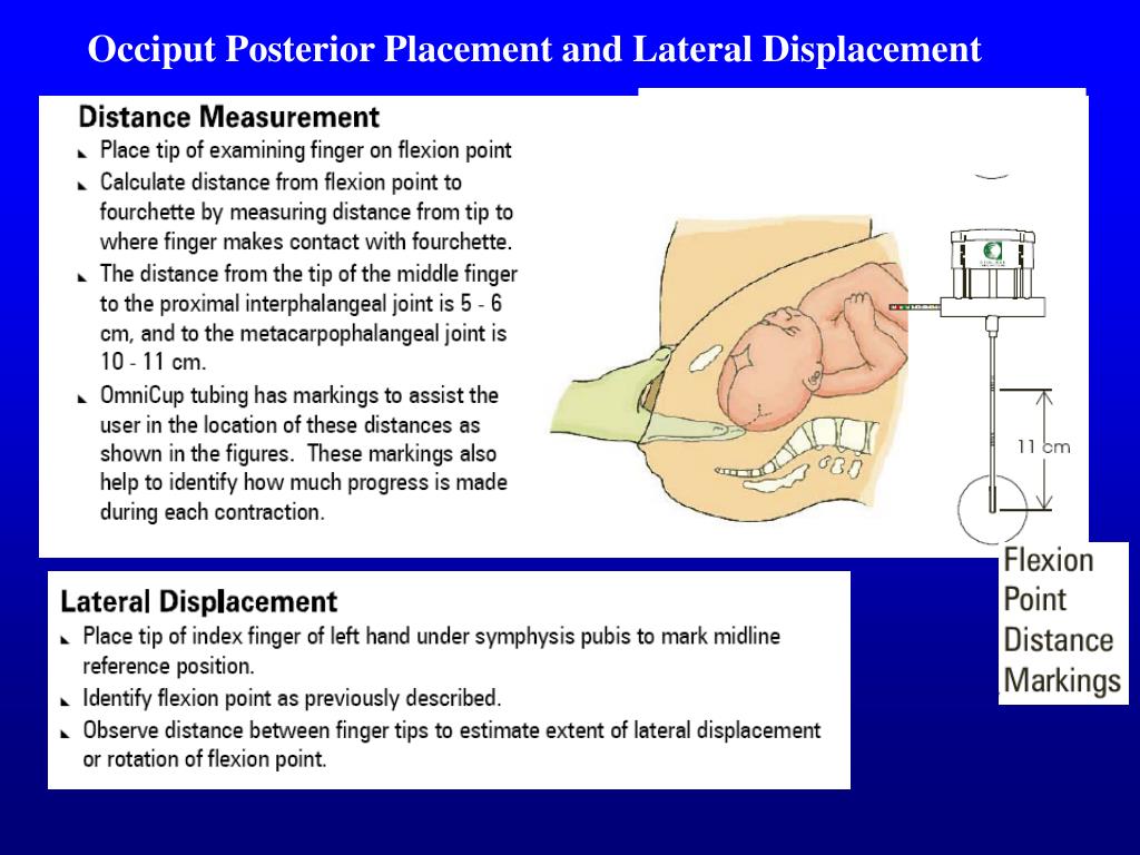 PPT Vacuum Assisted Vaginal Delivery PowerPoint Presentation, free