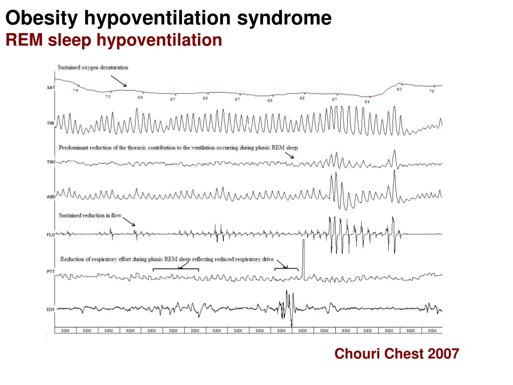 PPT Sleeprelated hypoventilation syndromes PowerPoint Presentation