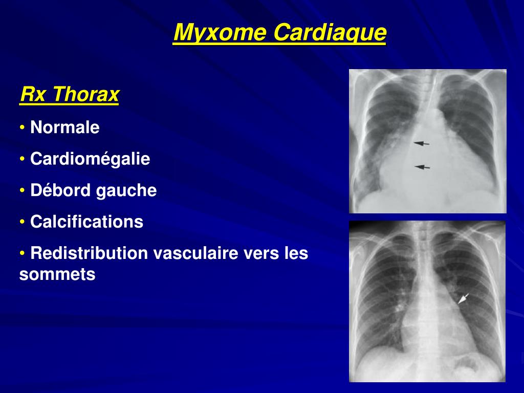 PPT Myxome Cardiaque PowerPoint Presentation, free download ID4745926