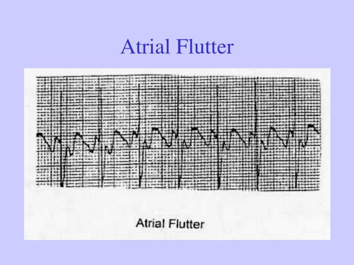 PPT Supraventricular Arrhythmia PowerPoint Presentation ID4749656