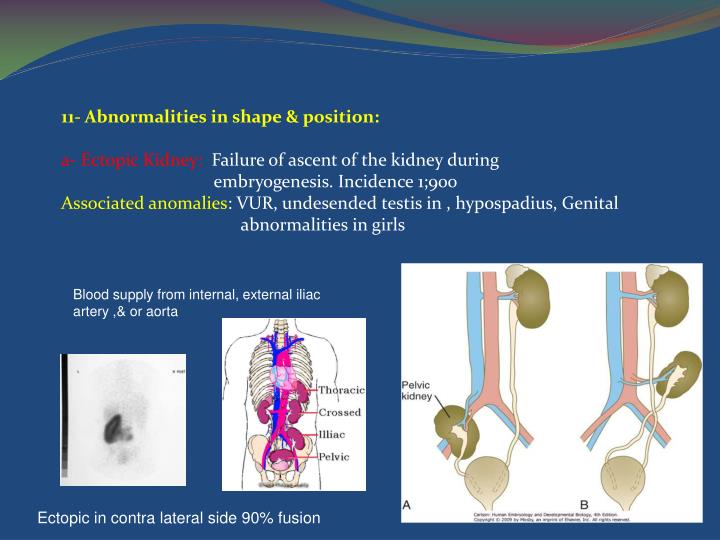 PPT Congenital anomalies of kidney and urinary system PowerPoint