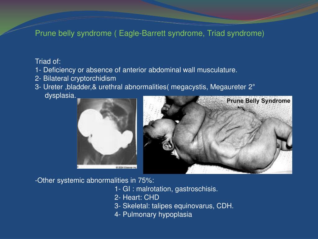 PPT Congenital anomalies of kidney and urinary system PowerPoint Presentation ID4756261