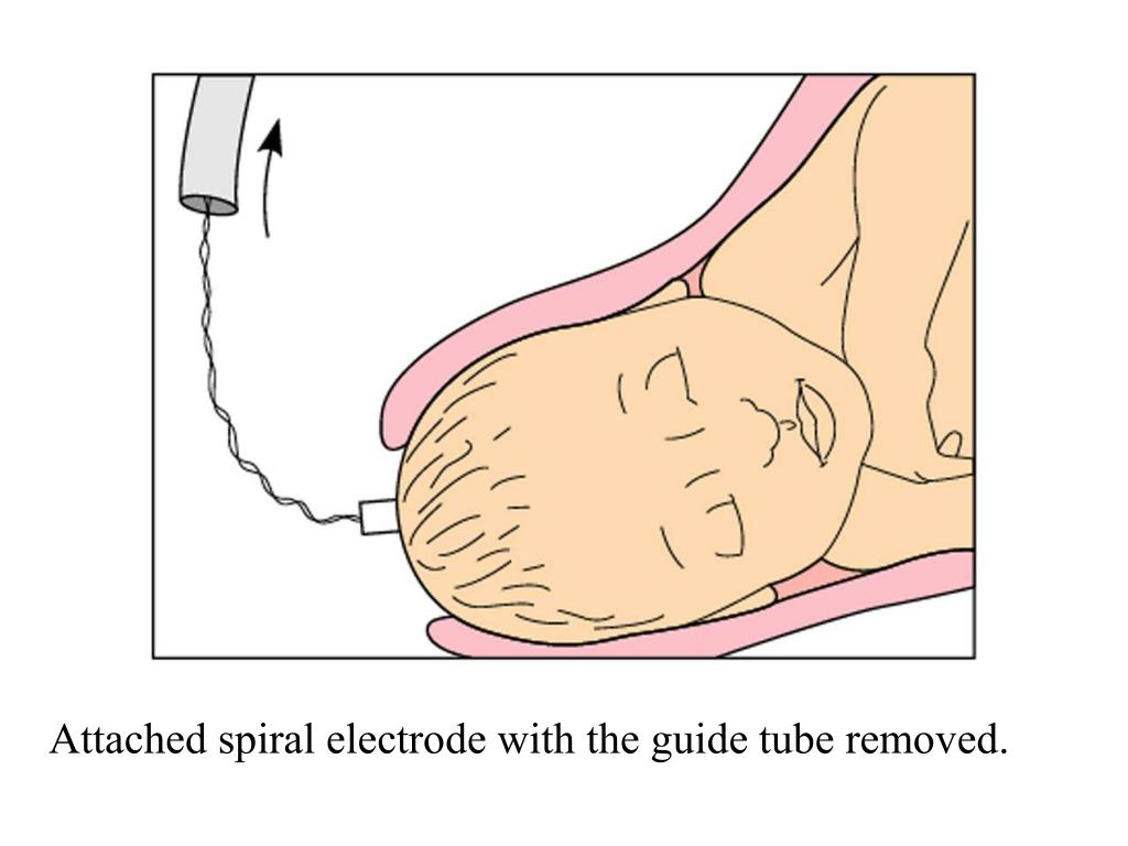 How Do Fetal Scalp Electrodes Work at James Curry blog