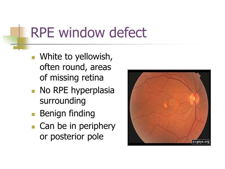 PPT Vitreous & Peripheral Retinal Anomalies PowerPoint Presentation