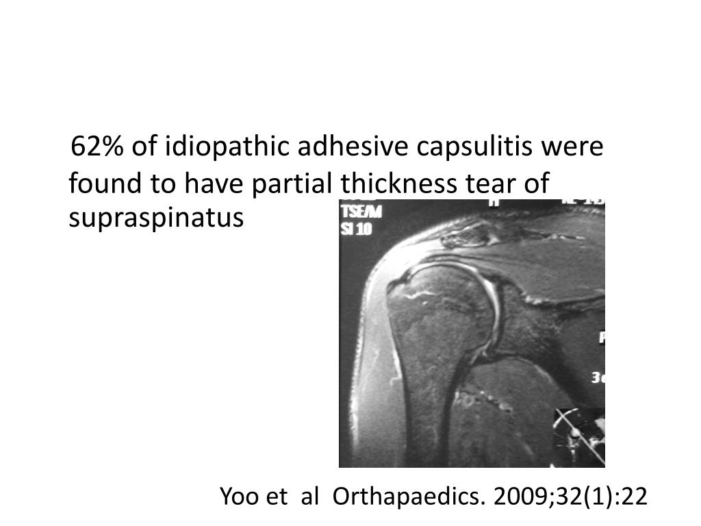 PPT ADHESIVE CAPSULITIS PowerPoint Presentation, free download ID