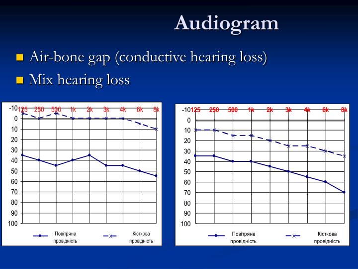 PPT OTITIS MEDIA and its complications prof. O.I.Yashan PowerPoint Presentation ID4793966