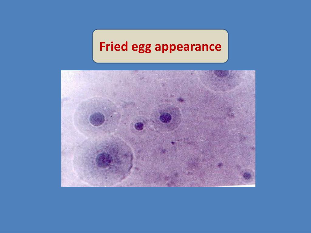 Mycoplasma Pneumoniae Fried Egg Appearance