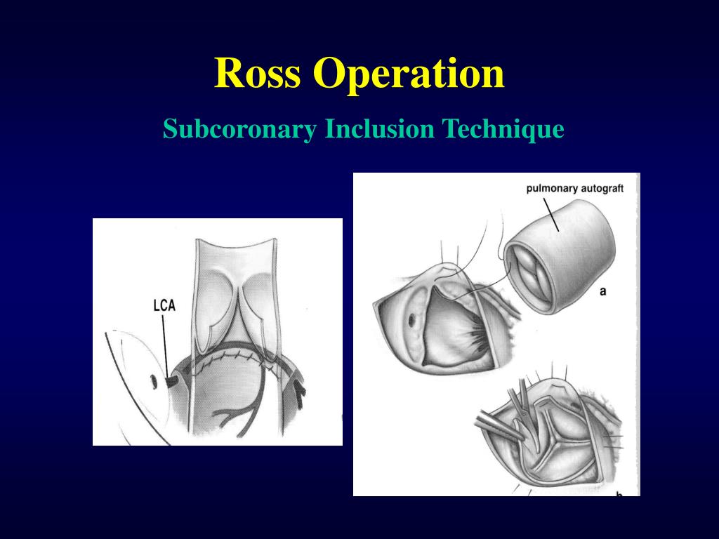 PPT Ross Operation PowerPoint Presentation, free download ID4813686