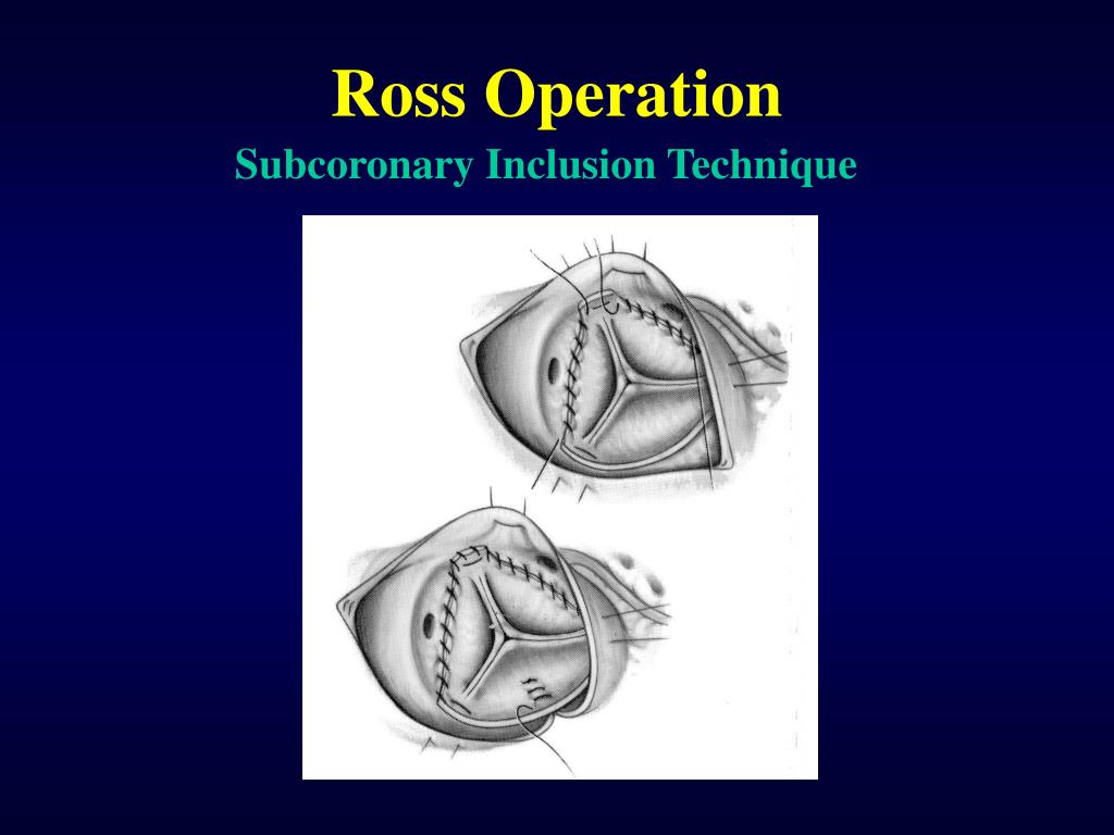 PPT Ross Operation PowerPoint Presentation, free download ID4813686