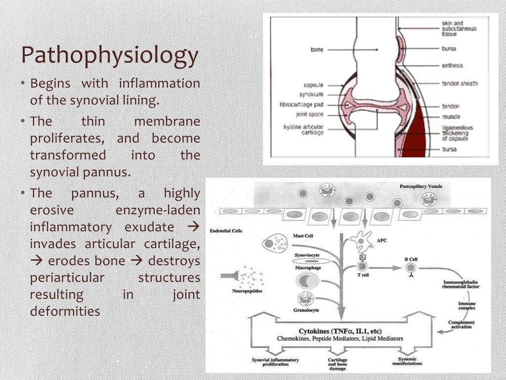 PPT RHEUMATOID ARTHRITIS PowerPoint Presentation, free download ID